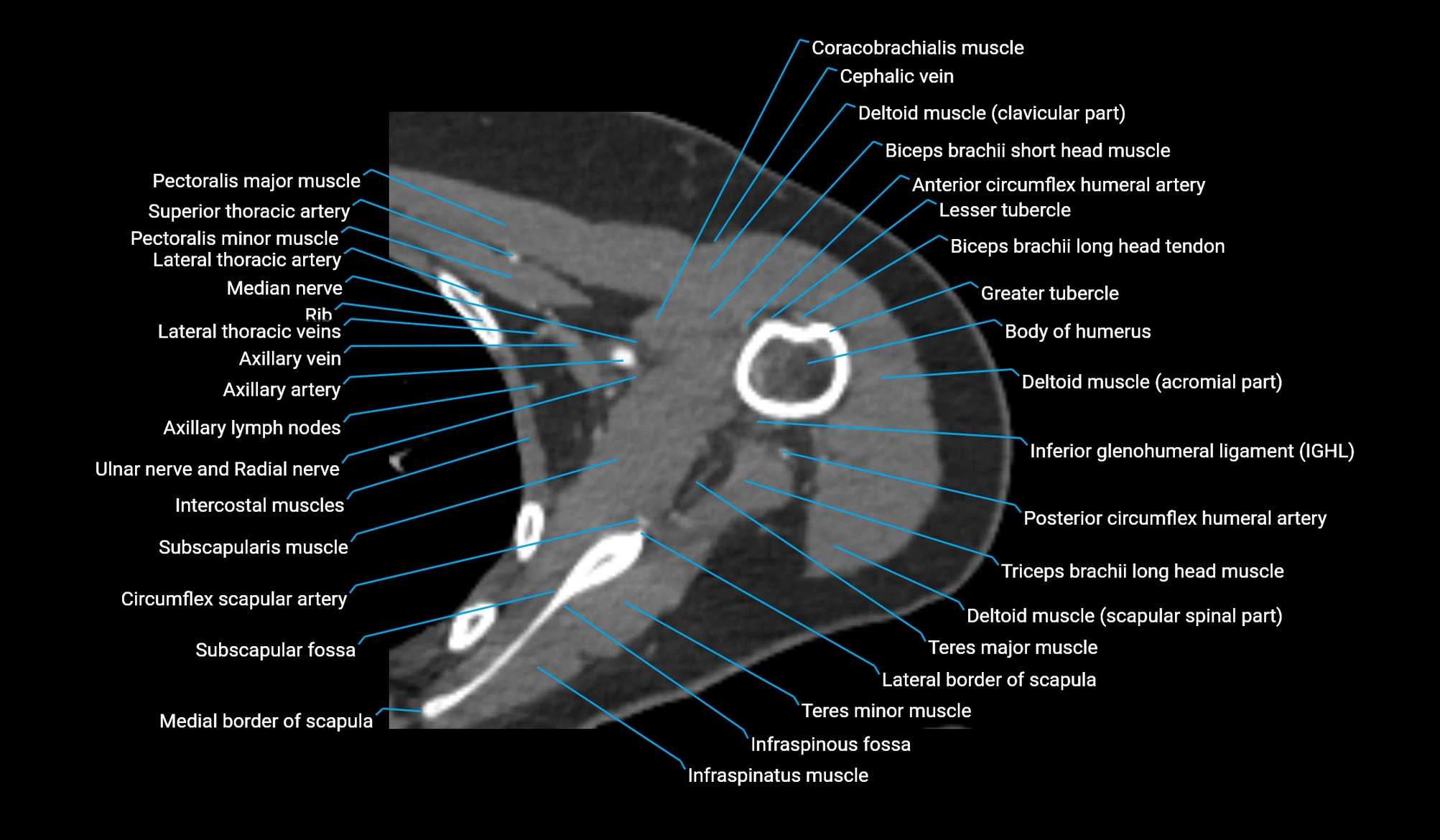 CT upper arm axial  cross sectional anatomy labelled radiology image -00122.webp